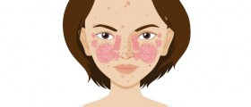 Lupus Vs Arthritis: What Are The Similarities And Differences?